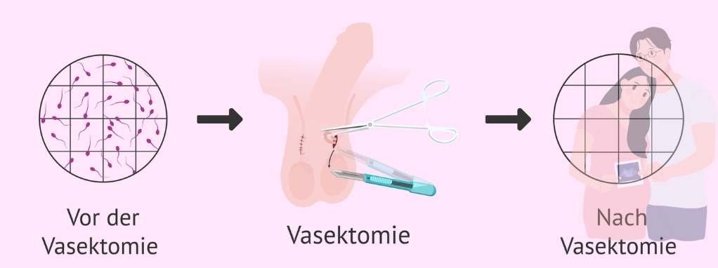 Was ist Azoospermie? Symptome, Ursachen und Behandlung